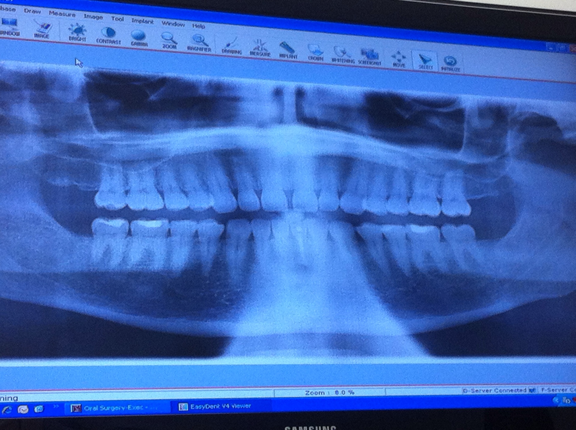 Bone spicule that was causing a lot of pain in my mouth following wisdom tooth surgery.